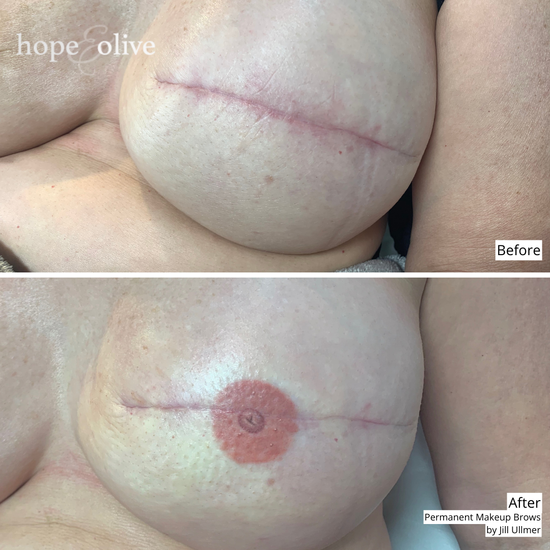 Areola Restoration 